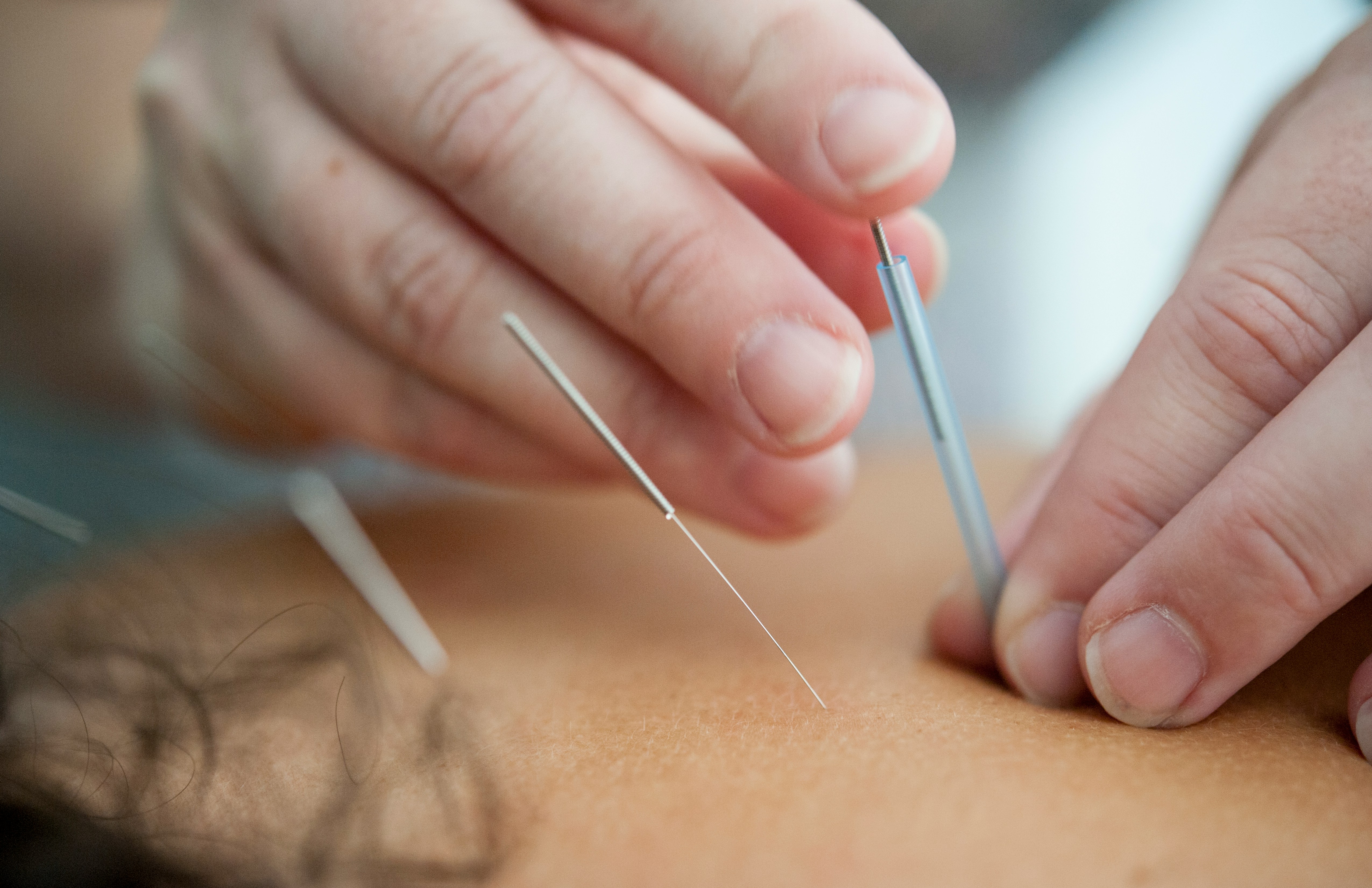 A picture of acupuncture